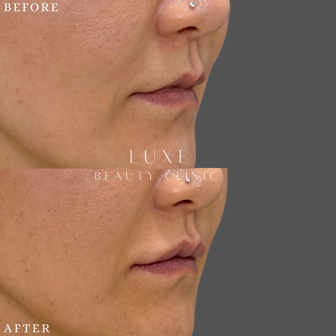 ヒアルロン酸注入　上唇